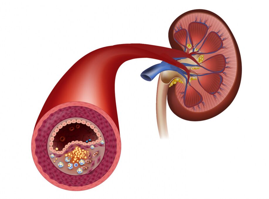 A véráramlás csökkentése az atherosclerosis miatt